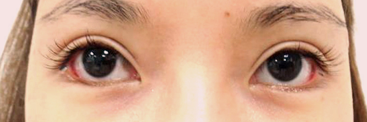 眼瞼の形成の症例画像