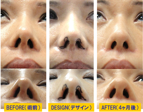 鼻 傷跡修正症例01