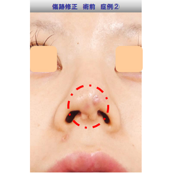 鼻の傷跡修正症例02