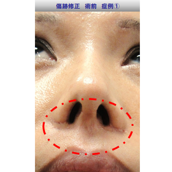 鼻の傷跡修正症例01