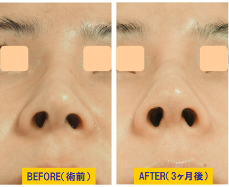 鼻整形修正症例3