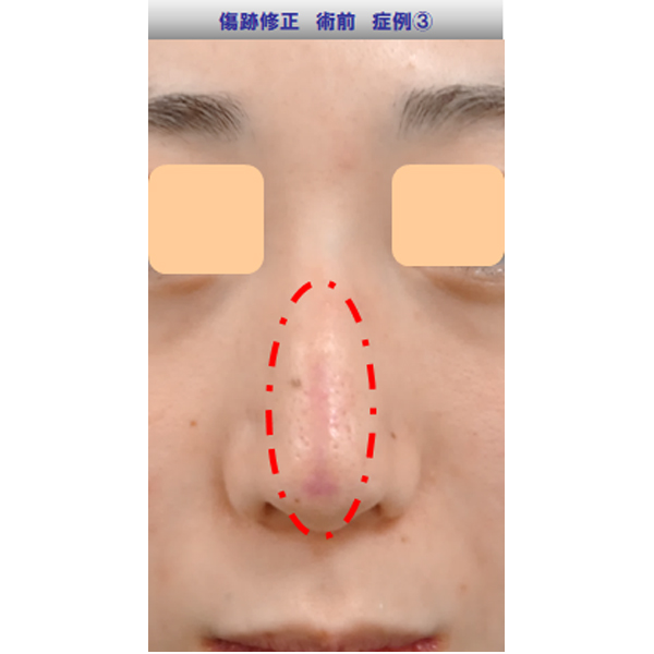 鼻の傷跡修正症例03