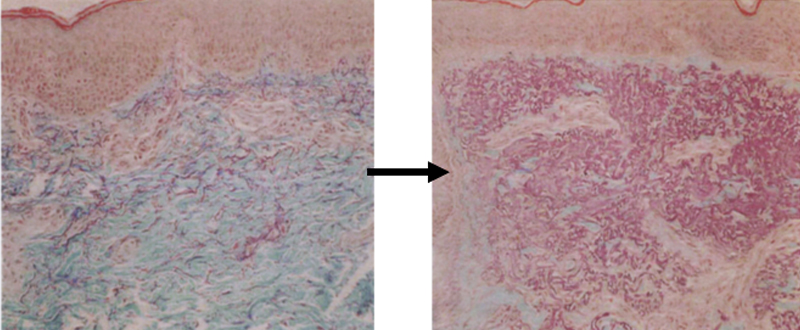 ダーマローラーによって増殖した真皮層のコラーゲン繊維層