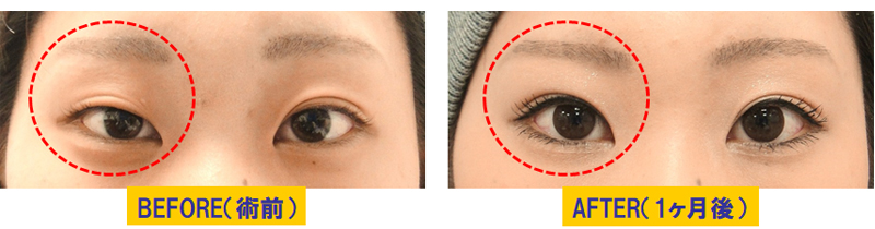 眼瞼下垂治療＆目の左右差改善