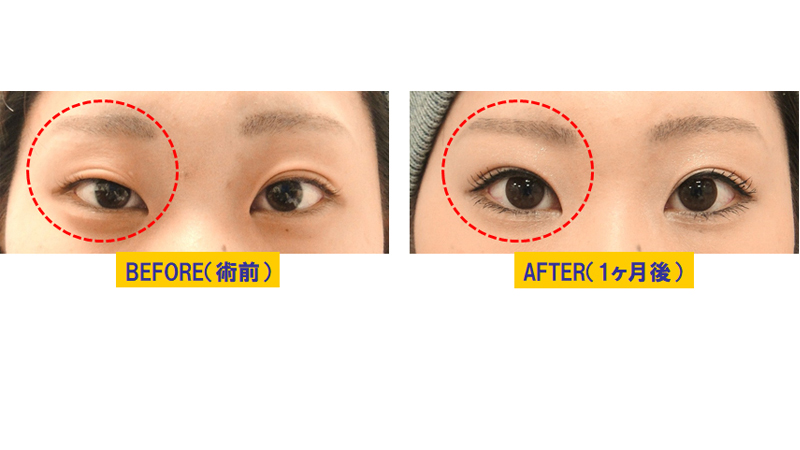 眼瞼下垂の術後修正