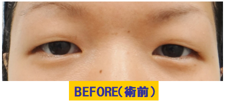 中等度以上の腫れぼったい若年性眼瞼下垂の例