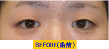 蒙古ヒダツッパリタイプの若年性眼瞼下垂