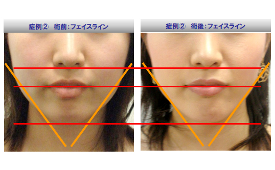 顔面脂肪吸引＆輪郭Vライン形成スライド2