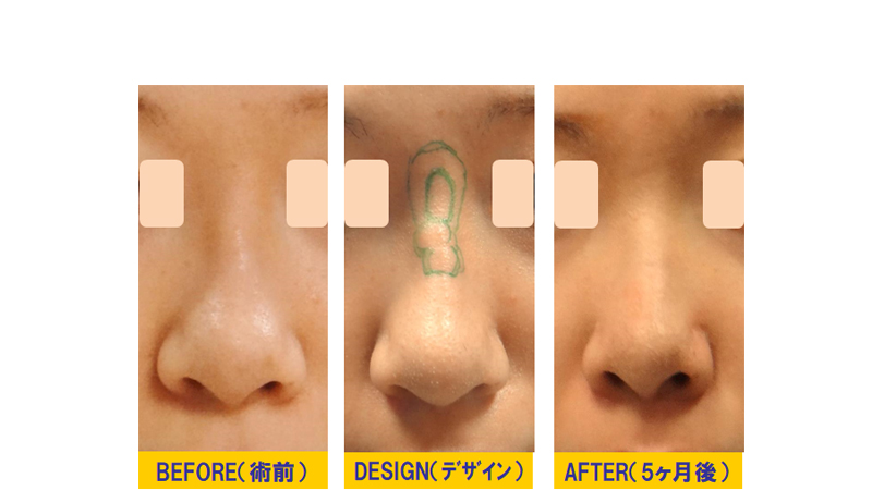 鼻の不溶性フィラー除去