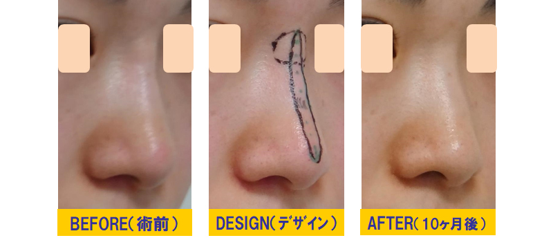 鼻の不溶性フィラー除去症例02斜め