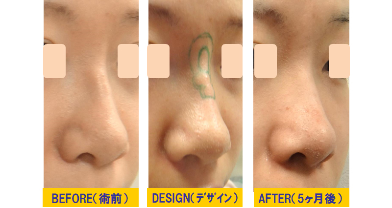 鼻の不溶性フィラー除去症例01斜め
