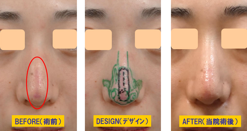 形成外科医による切開瘢痕の修正-鼻.jpg