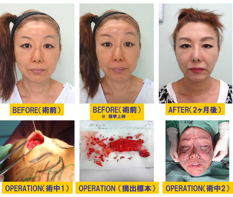 外傷後の顔面修正治療-症例3