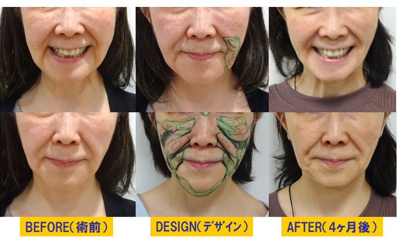 顔全体のFGF治療症例3