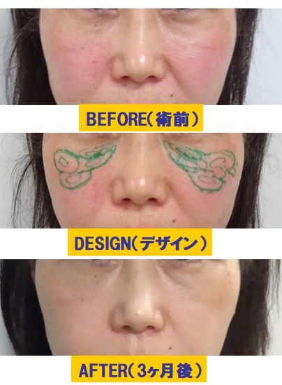 顔全体のFGF治療症例2