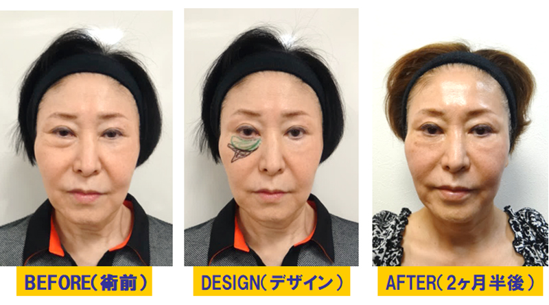 外傷後の顔面修正治療-症例1