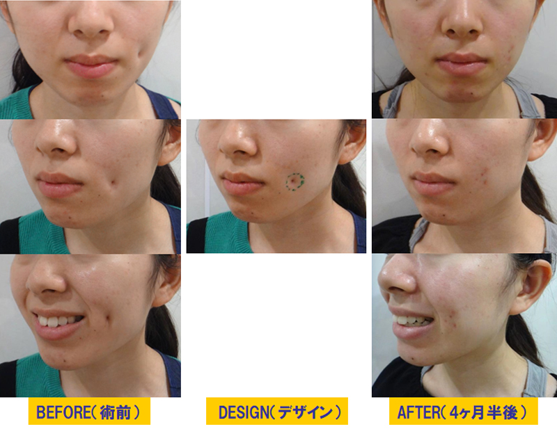 外傷後の顔面修正治療-症例2