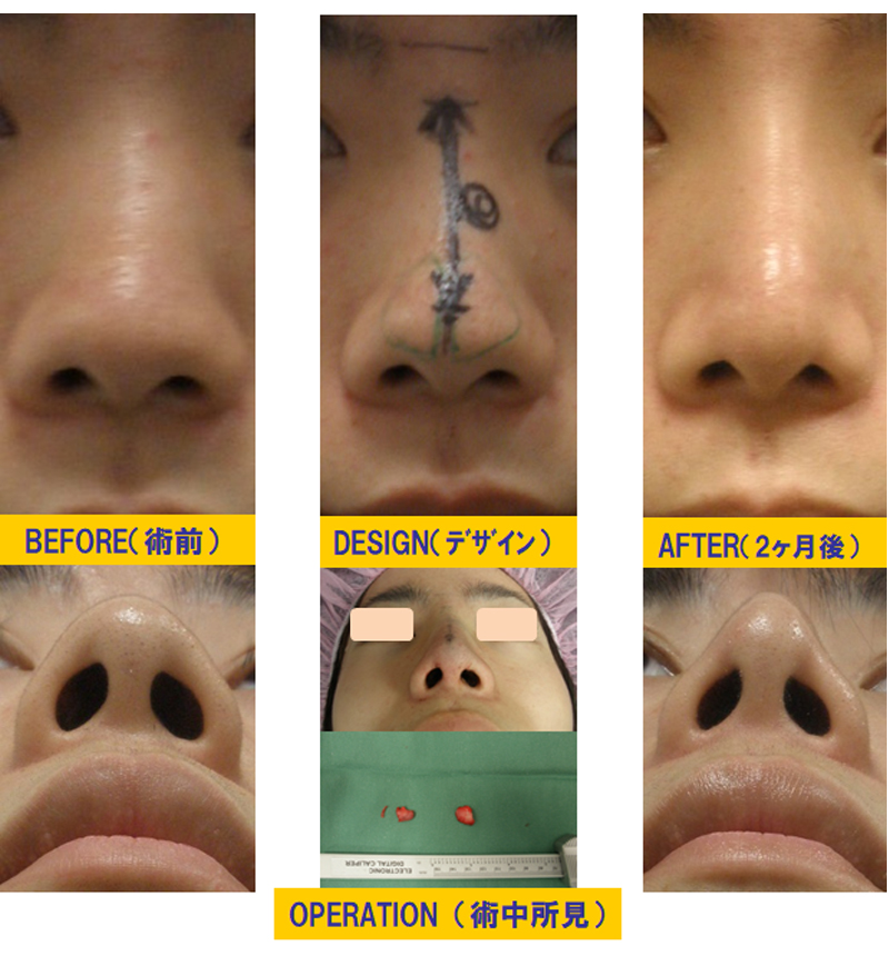 団子鼻改善目的での鼻尖軟骨切除＆隆鼻術-症例3