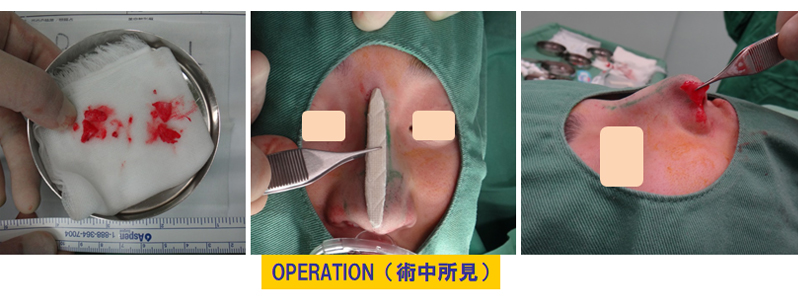 団子鼻改善目的での鼻尖軟骨切除＆隆鼻術-症例1の術中画像