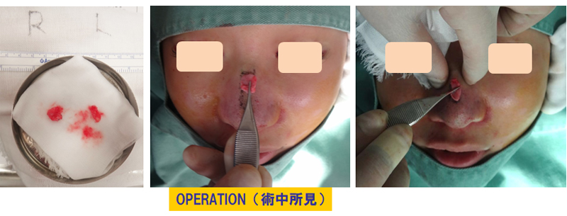 団子鼻改善目的での鼻尖軟骨切除＆隆鼻術-症例2の術中画像