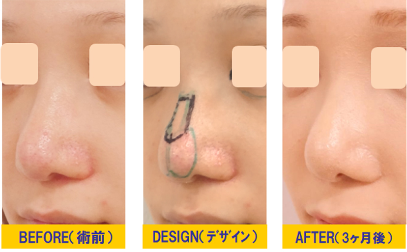 団子鼻改善目的での鼻尖軟骨切除＆隆鼻術-症例2
