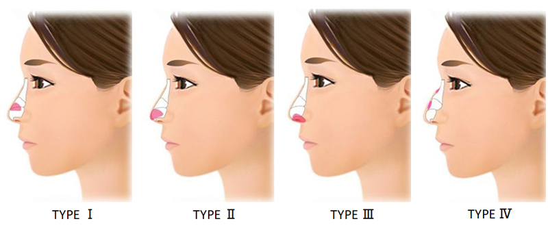 鼻尖軟骨切除＆再移植術の移植先タイプ別の分類