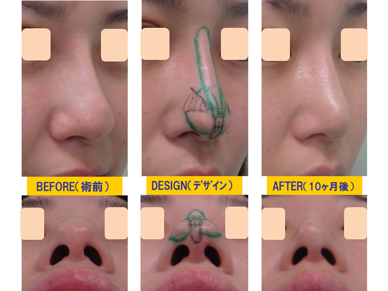 団子鼻改善目的での鼻尖軟骨切除＆隆鼻術-症例1