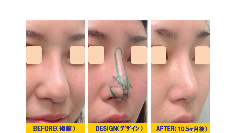下垂型ダンゴ鼻の改善術