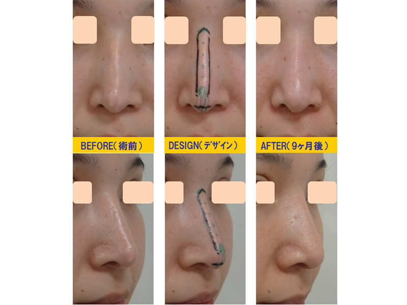 他院3D鼻尖形成術の修正-症例2-1