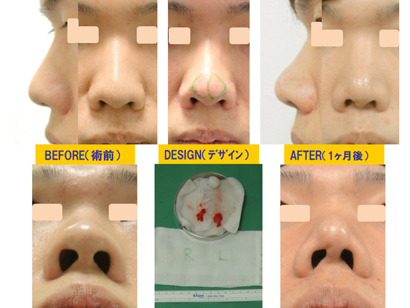 団子鼻改善目的での鼻尖軟骨切除-症例3