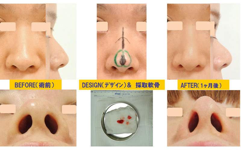 団子鼻改善目的での鼻尖軟骨切除-症例2