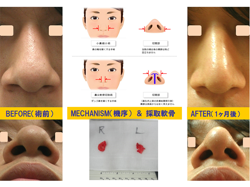 団子鼻改善目的での鼻尖軟骨切除-症例1