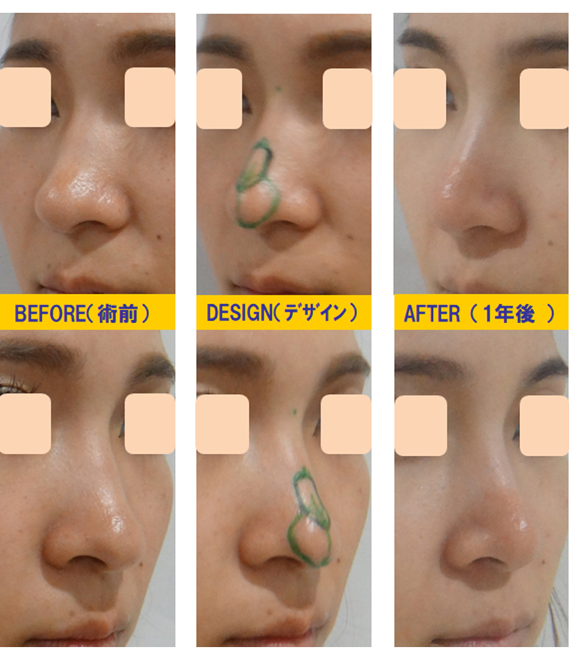 ブーツ型の団子鼻改善目的での鼻尖軟骨切除＆再移植術-症例1