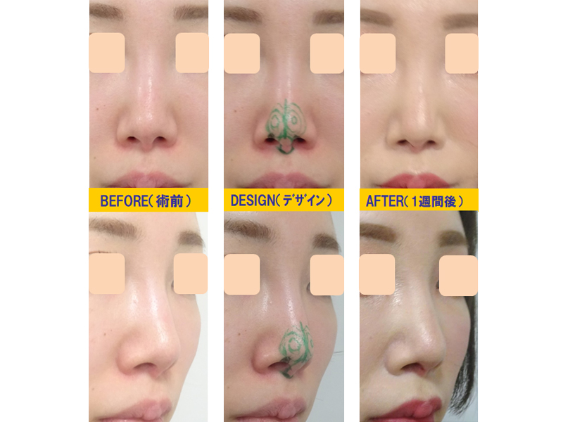 他院3D鼻尖形成術の修正-症例3-1
