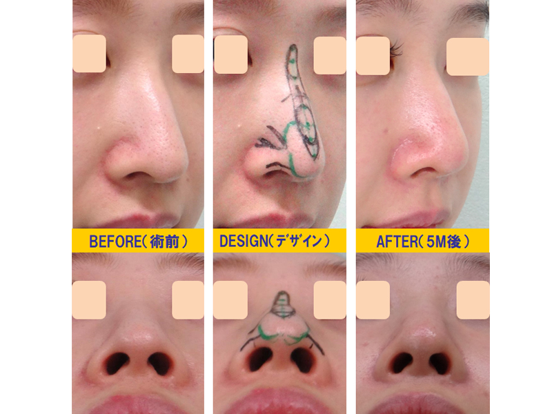 下垂鼻改善-症例2