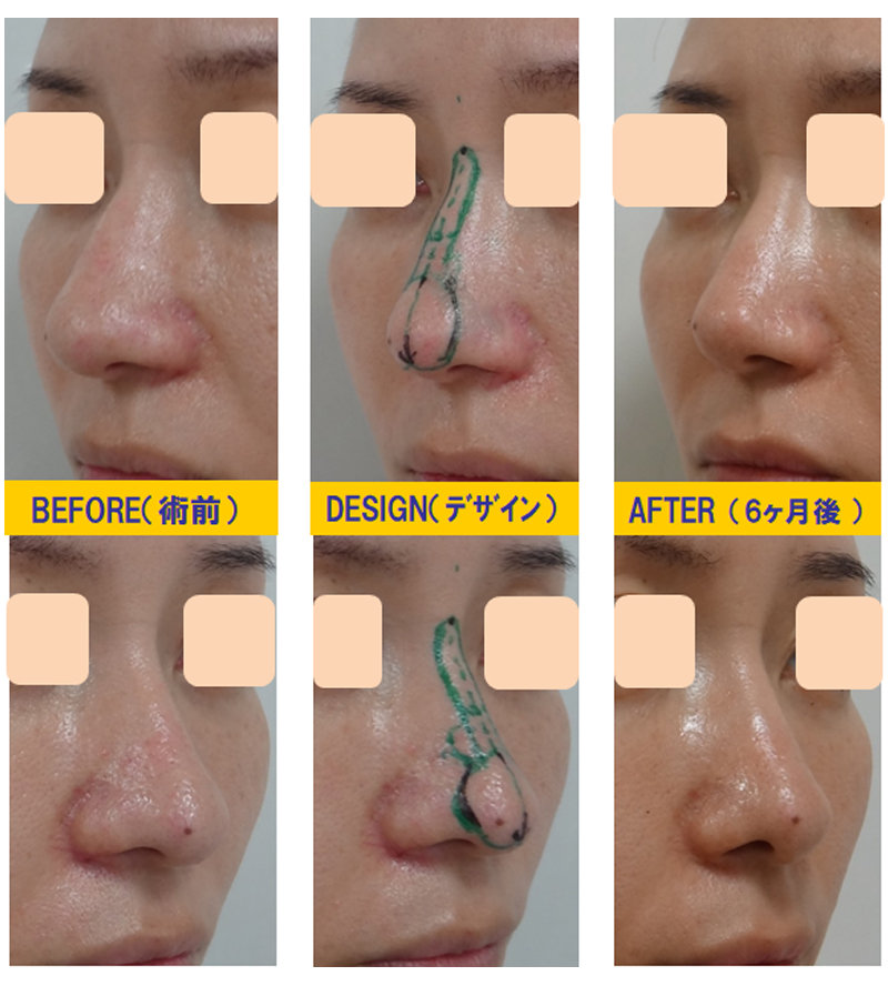 ブーツ型の団子鼻改善目的での鼻尖軟骨切除＆再移植術-症例3