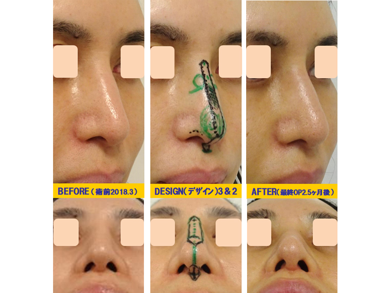 下垂鼻改善-症例3