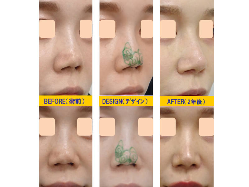 他院3D鼻尖形成術の修正-症例1-1