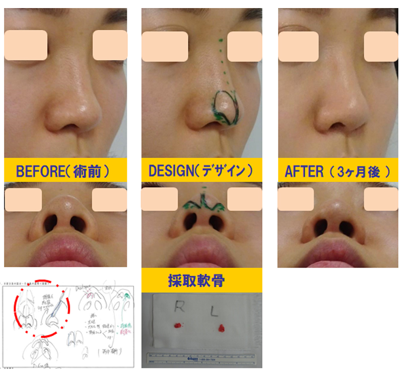 ブーツ型の団子鼻改善目的での鼻尖軟骨切除＆再移植術-症例2