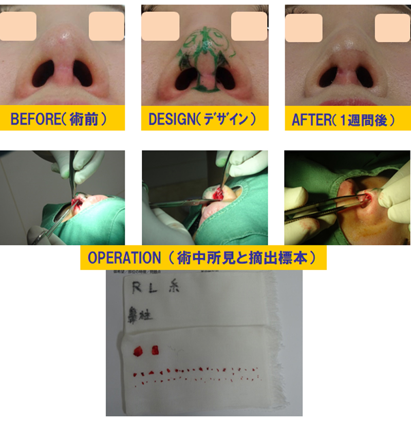 他院3D鼻尖形成術の修正-症例3-2
