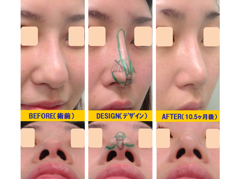 下垂鼻改善-症例1