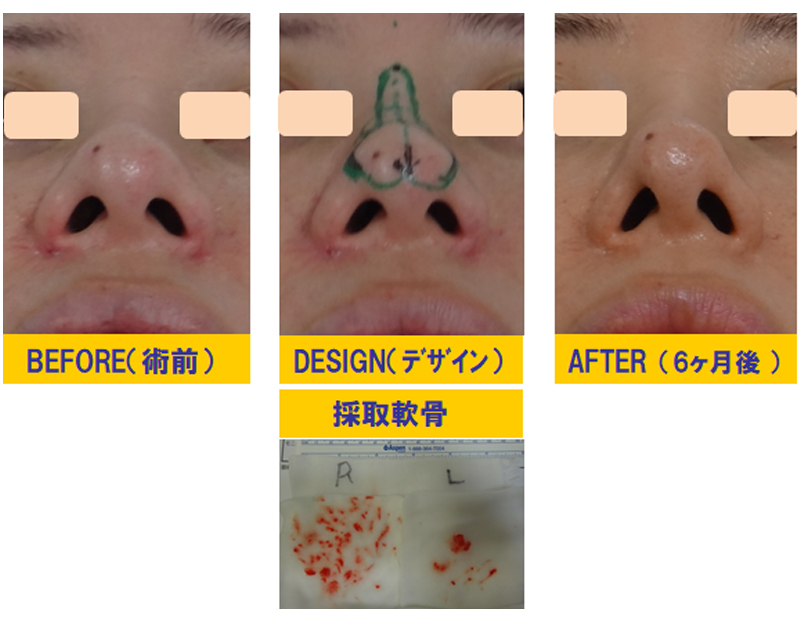 ブーツ型の団子鼻改善目的での鼻尖軟骨切除＆再移植術-症例3-2