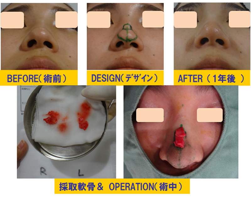 ブーツ型の団子鼻改善目的での鼻尖軟骨切除＆再移植術-症例1-2