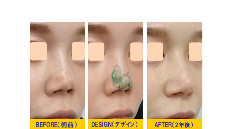 他院での3D鼻尖形成術の修正