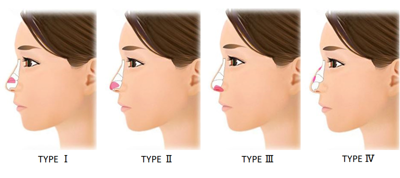 鼻尖軟骨切除＆再移植術の移植先タイプ別分類