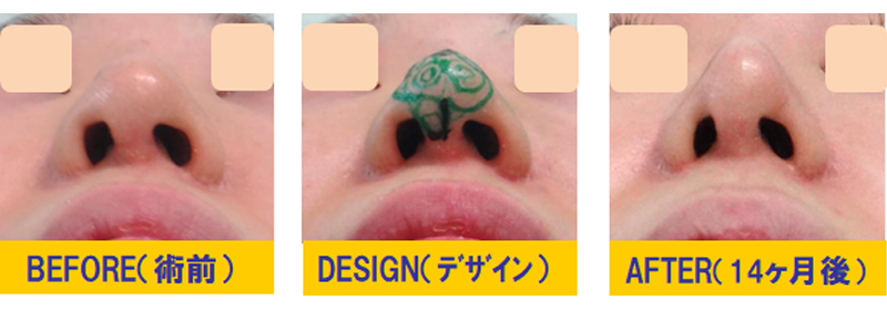 鼻孔過剰狭小化・鼻孔左右差の修正-症例2