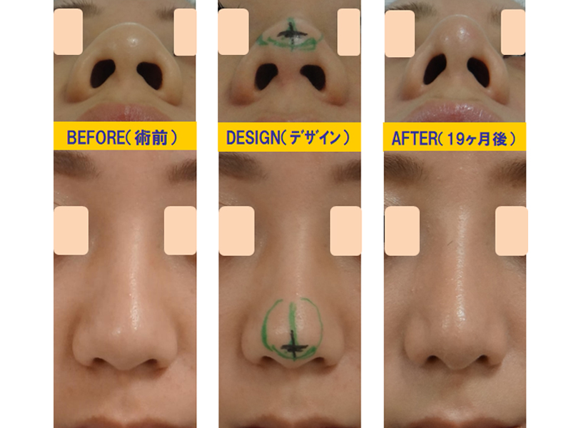 完全クローズ法で鼻孔の形を変える手術-症例2