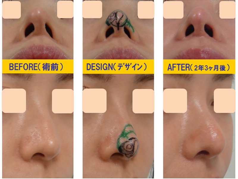 鼻孔過剰狭小化・鼻孔左右差の修正-症例1
