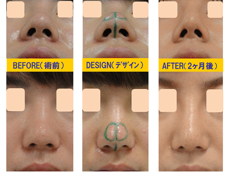 完全クローズ法で鼻孔の形を変える手術-症例1