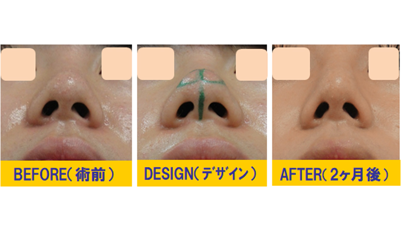 完全クローズ法で鼻孔の形を変える手術